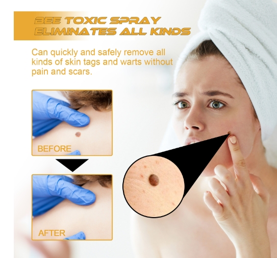 Cure warts spray