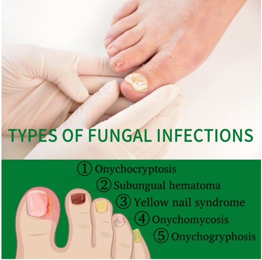 Whitenail Repair, Hand, Foot, Nail Care, Soft Nail Brightening and Moisturizing Liquid