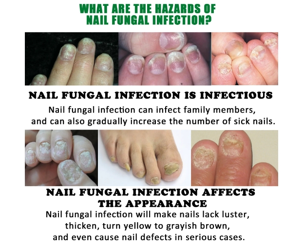 Whitenail Repair, Hand, Foot, Nail Care, Soft Nail Brightening and Moisturizing Liquid